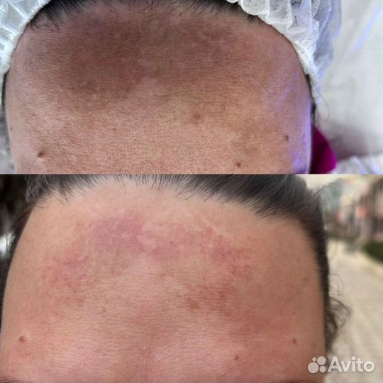 Ручной массаж, элос-Омоложение, элос-эпиляция