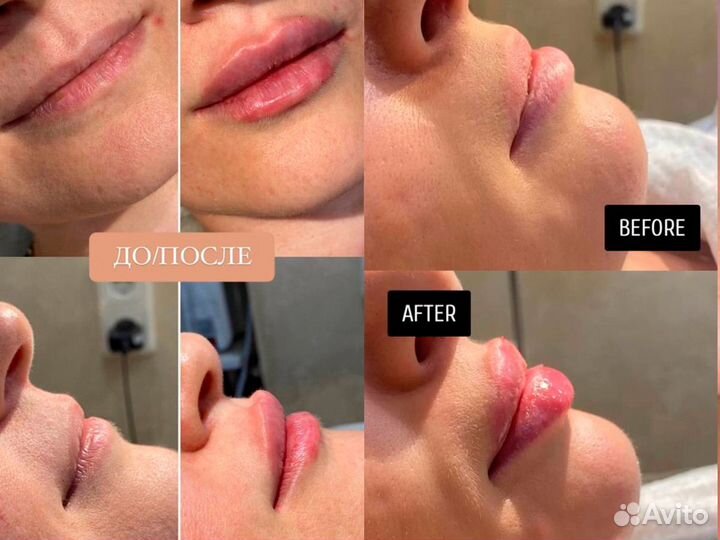 Увеличение губ, пиллинг, био, мезо