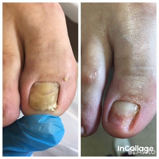 Педикюр/подология/ выезд на дом