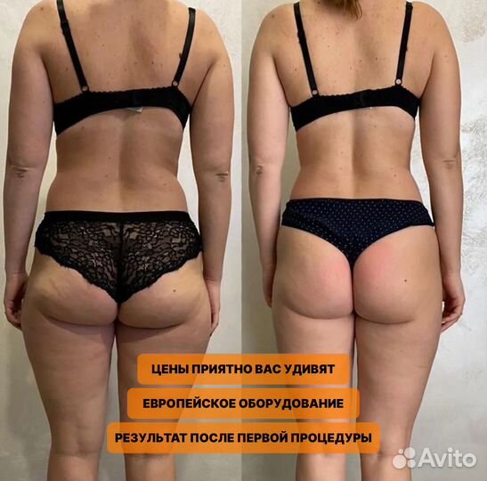 Lpg массаж / Антицеллюлитный массаж / Коррекция