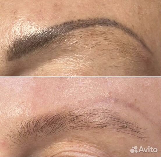 Удаление татуировок