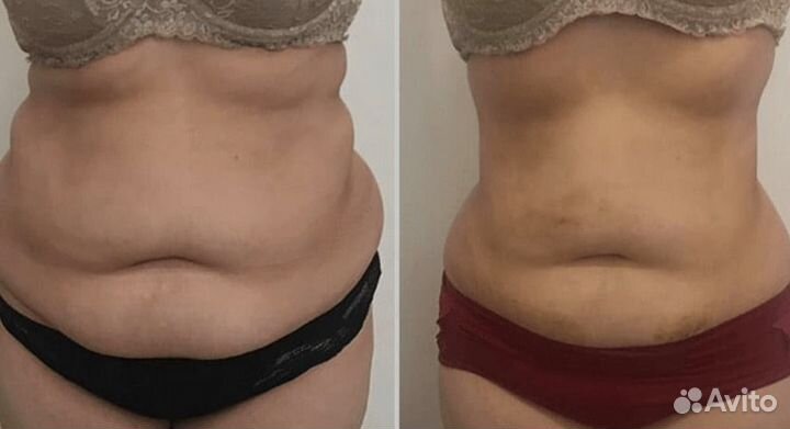 Липолитики