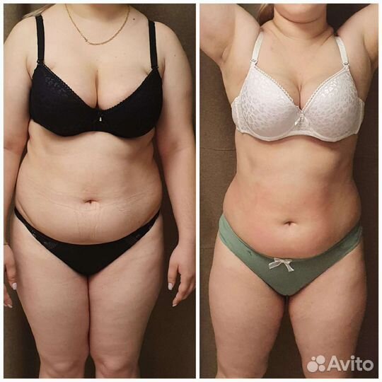 Криолиполиз,коррекция фигуры,похудение