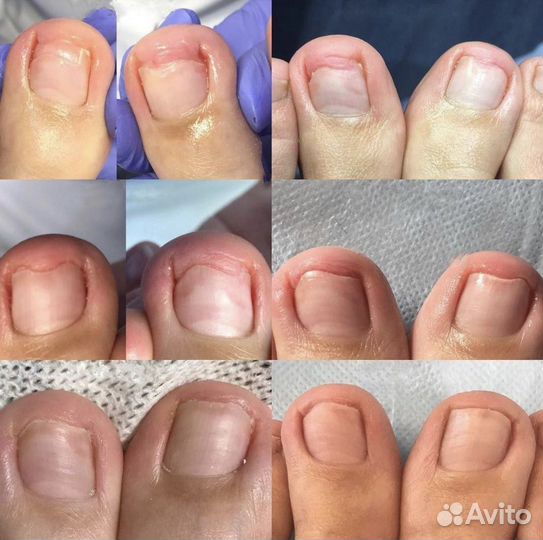 Подологический педикюр