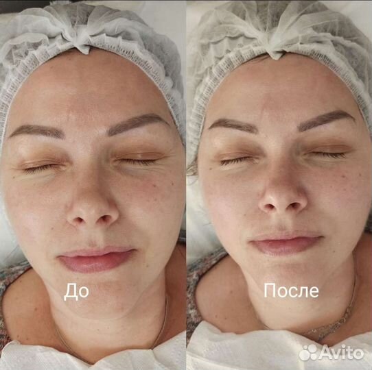 Лазерная эпиляция