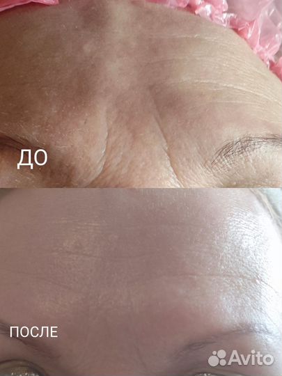 Аппаратный массаж, коррекция фигуры, чистки лица