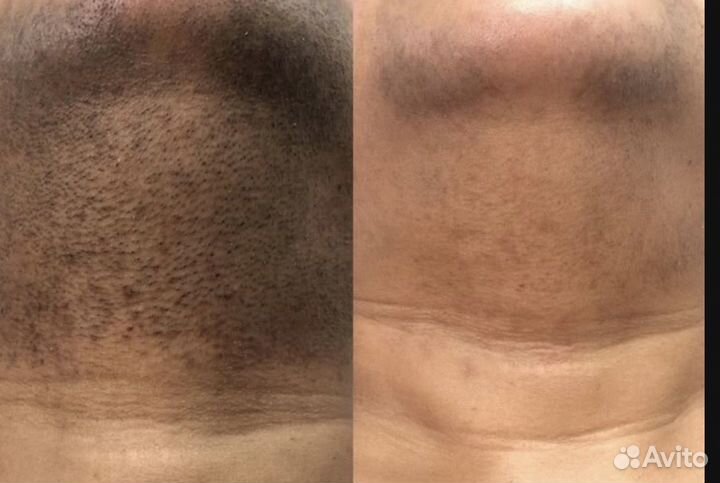 Лазерная эпиляция Диодный Лазер Депиляция