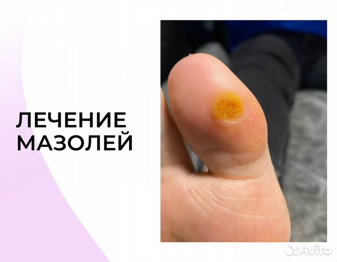 Подолог. Вросший ноготь. Мозоли. Бородавки/Педикюр