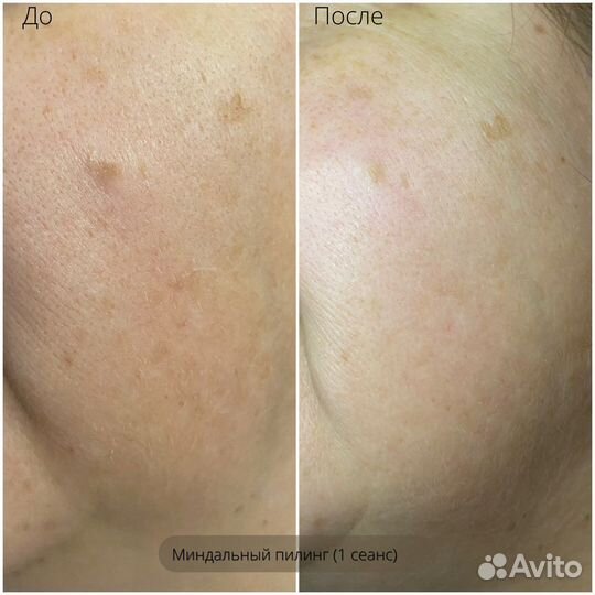 Массаж лица