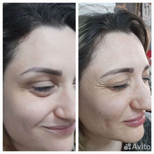 Ботокс требуются модели