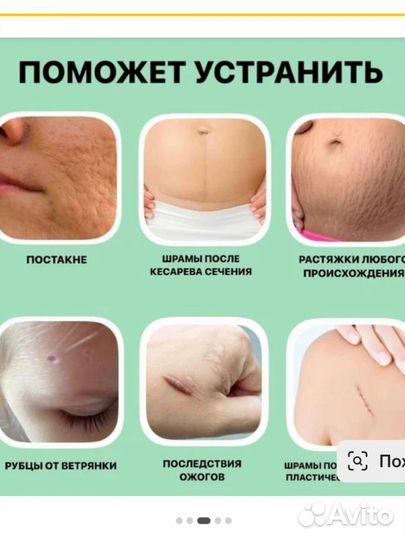 Крем Гель дерматикс для коррекции кожных дефектов