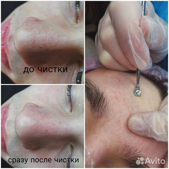 Комбинированная чистка лица