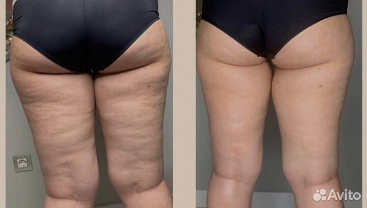 Липолитики