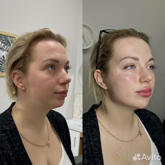 Требуются модели. Контурная пластика лица. Губы