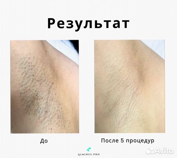 Аппарат для эпиляции Lumines’ Max One 1200в