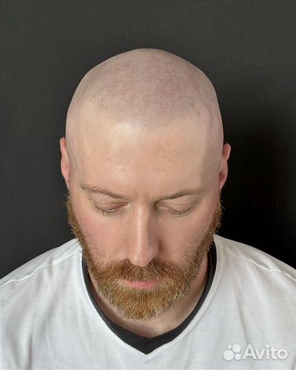 Трихопигментация SMP в Санкт-Петербурге