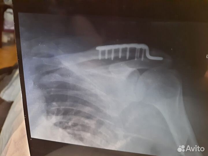 Титановая пластина на левую ключицу плеча