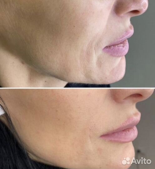 Подтяжка лица, rf-лифтинг