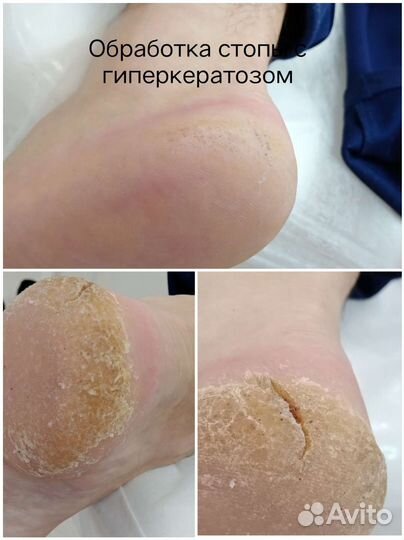 Подолог, аппаратный медицинский педикюр