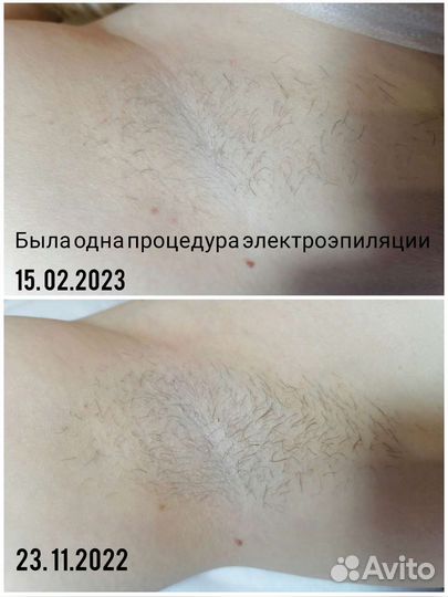 Электроэпиляция