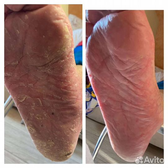 Подолог. Лечебный педикюр. Без боли