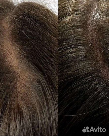 Плазмотерапия