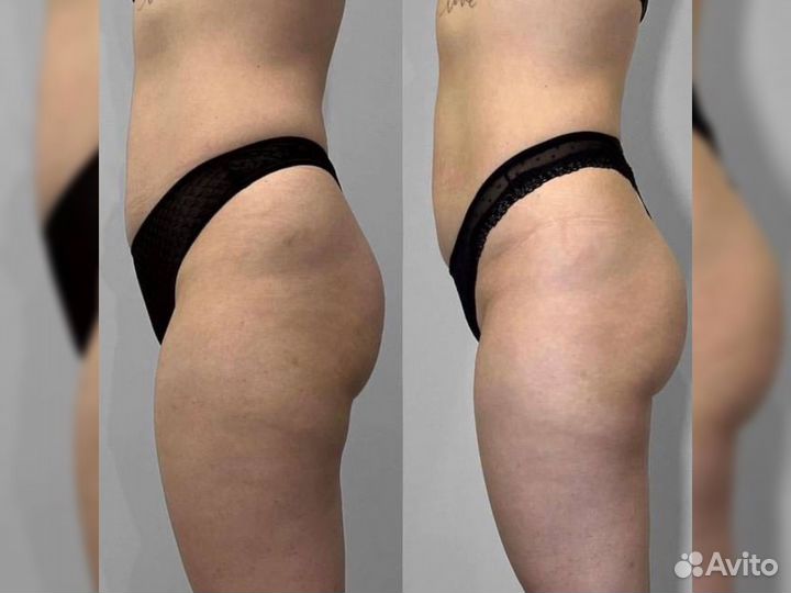 Липолитик. \ Устранение жировых отложений на теле