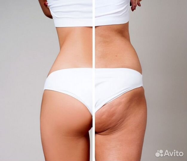 Аппаратный антицеллюлитный массаж