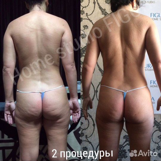 Антицеллюлитный массаж аппаратный, ручной