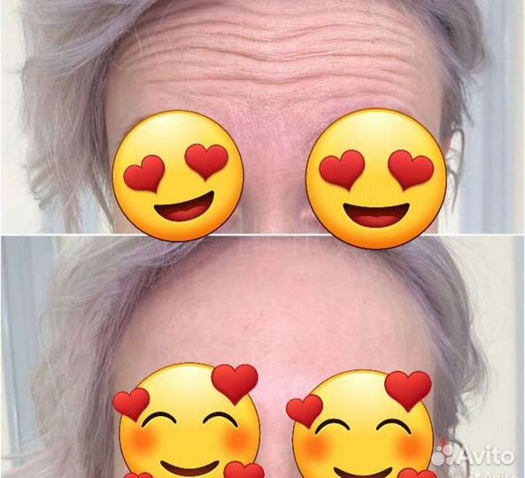 Модель на ботокс лица