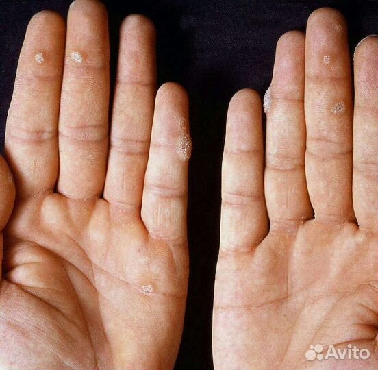 Грибок ногтей бородавки удаление