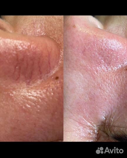 Холодная плазма.Омоложение