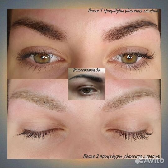 Удаление тату, татуажа, перманентного макияжа