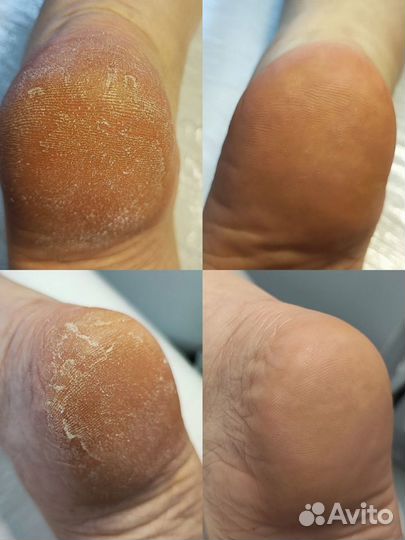 Smart-педикюр с покрытием гель-лак