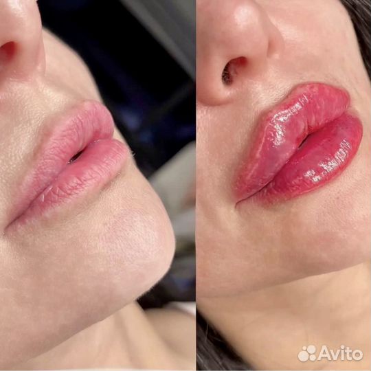 Косметолог с опытом, увеличение губ, профиль Джоли