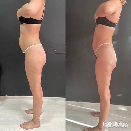 Вакуумный массаж кавитация rf