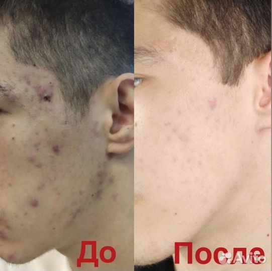 Хиджама обучение