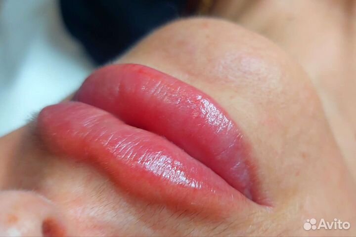 Увеличение губ