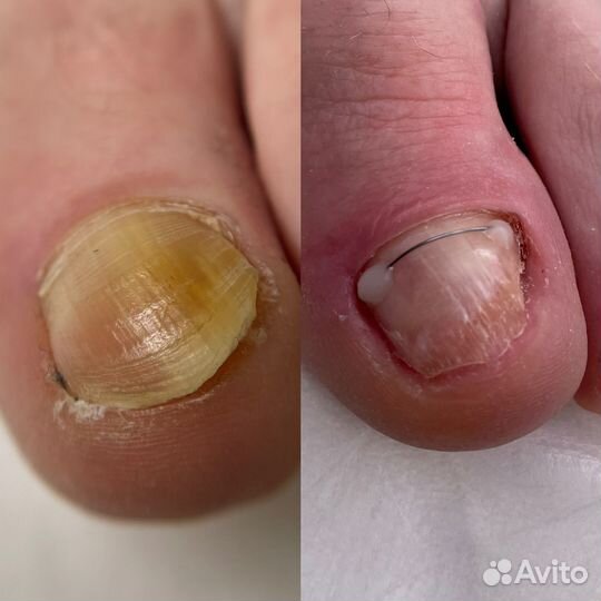Подолог. Вросший ноготь. Титановая нить
