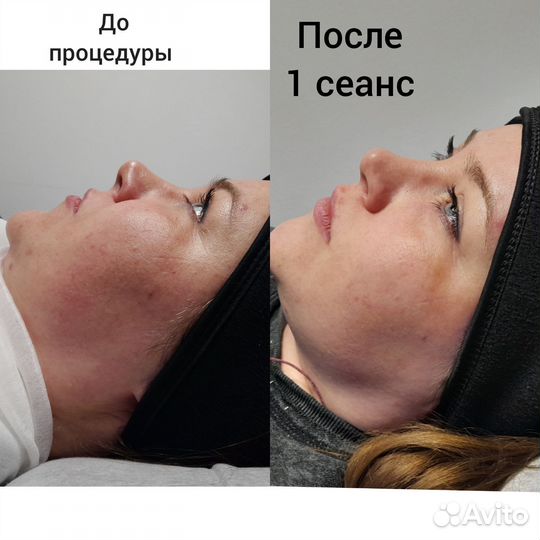 Карбоновый пилинг