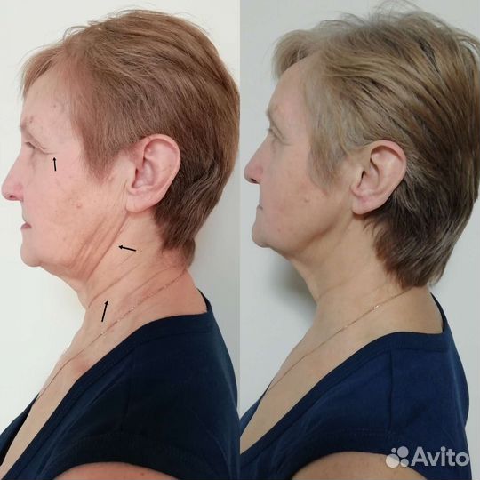 Витапластика