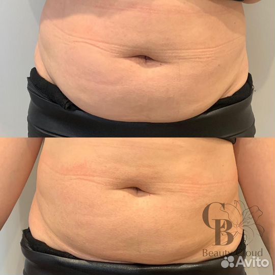 Холодная плазма. Обучение