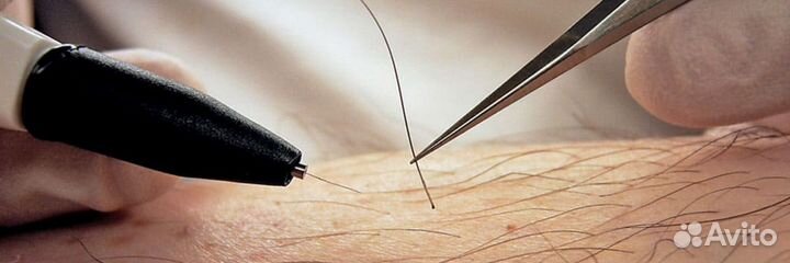 Электроэпиляция