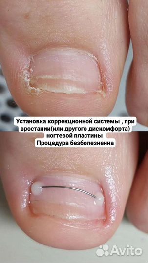 Титановая нить педикюр