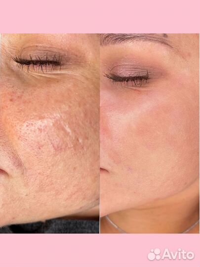 Комплекс Экспресс лифтинг