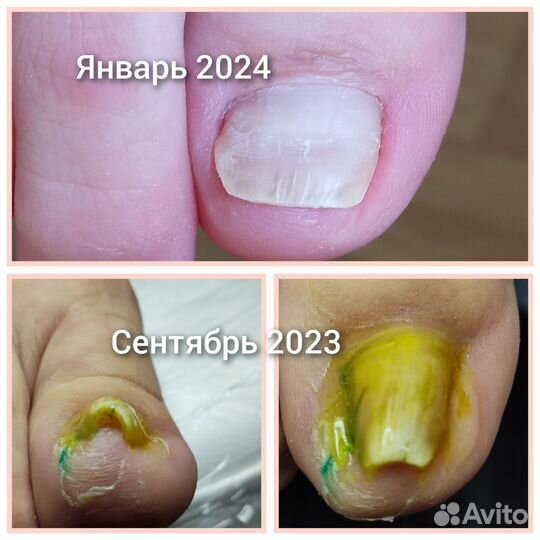 Педикюр для сложной стопы