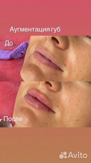 Увеличение губ