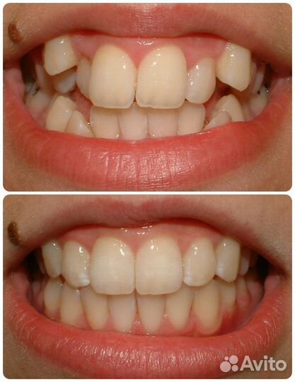 Модель на брекеты