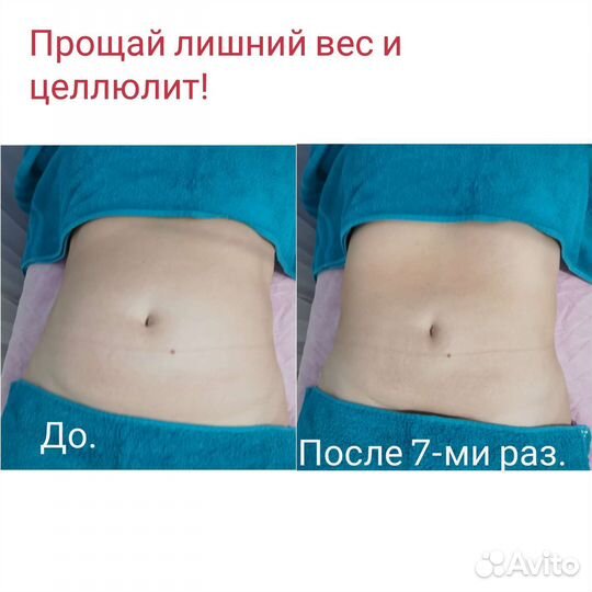 Вакуумно-роликовый массаж