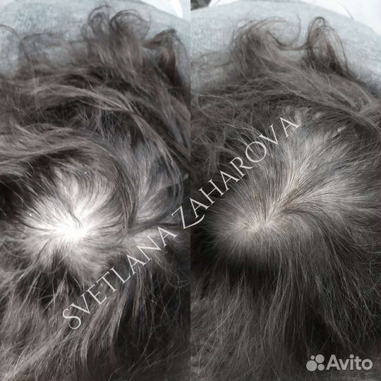 Трихопигментация